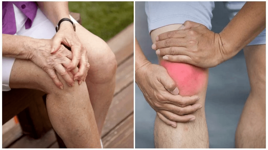 Điều trị bệnh viêm khớp