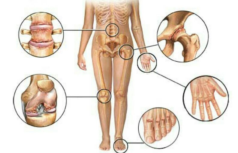 Các loại và mức độ của bệnh viêm khớp